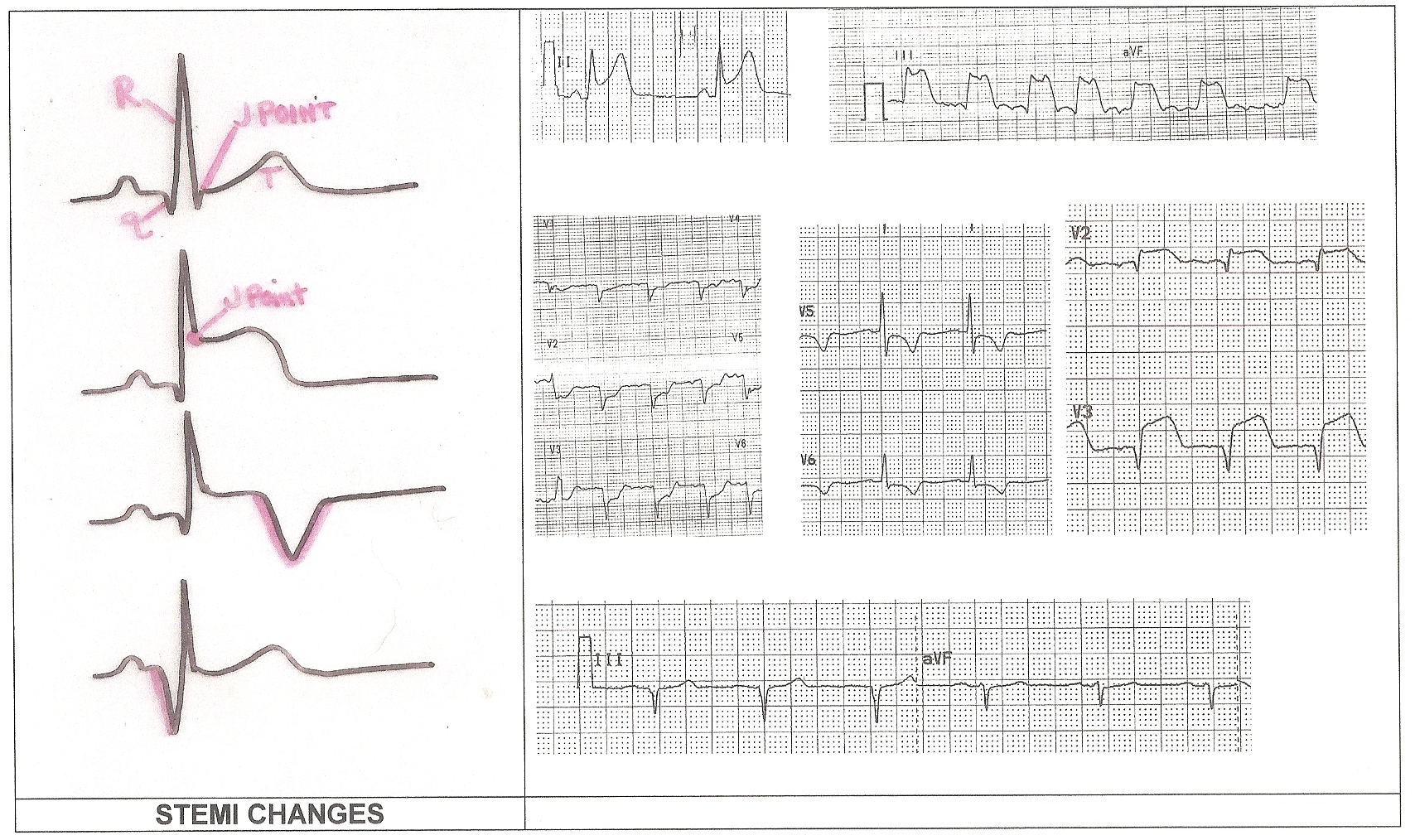 klonopin overdose ekg rhythms for dummies